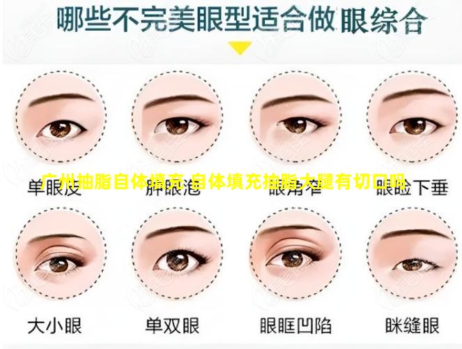 广州抽脂自体填充 自体填充抽脂大腿有切口吗